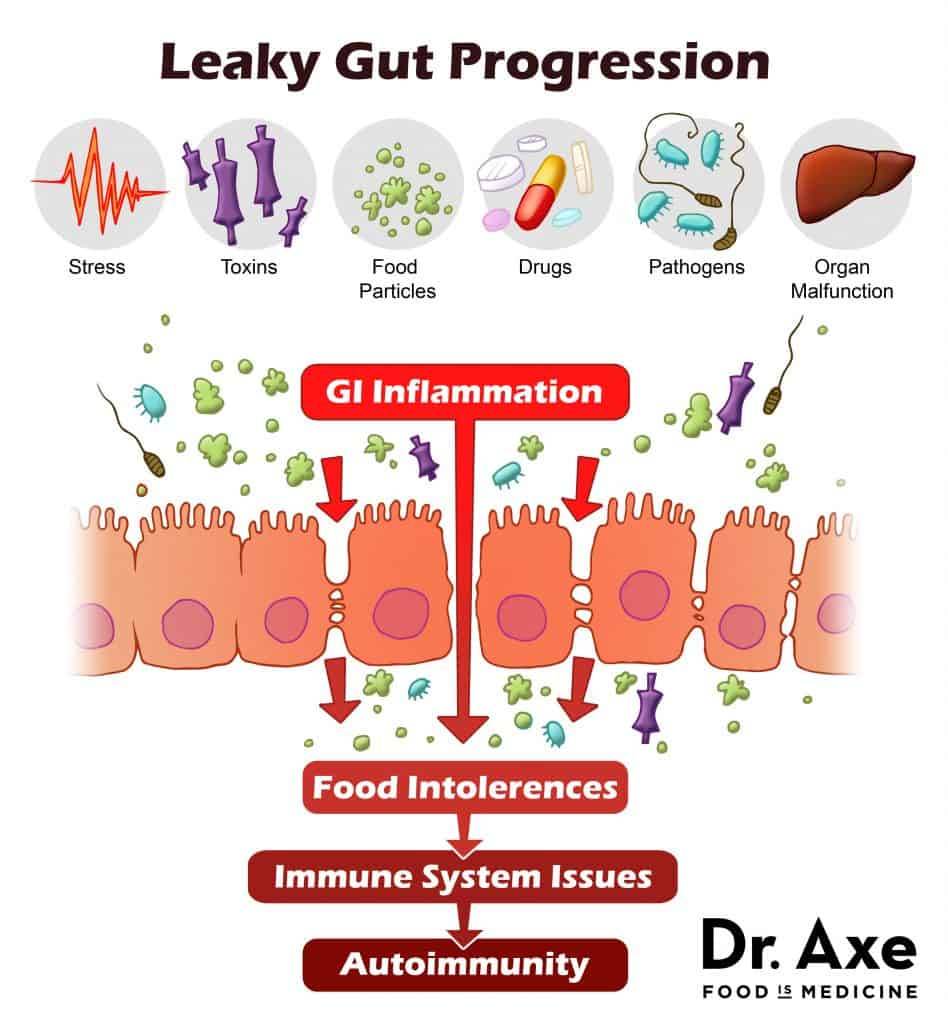 Common Food Sensitivities, what is leaky gut, what causes leaky gut, food intolerance symptoms, what is food intolerance
